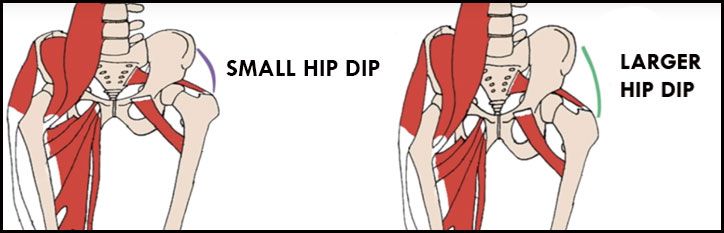 Hip dips are mostly the result of your skeletal anatomy