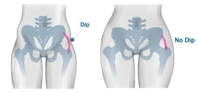 what causes hip dips