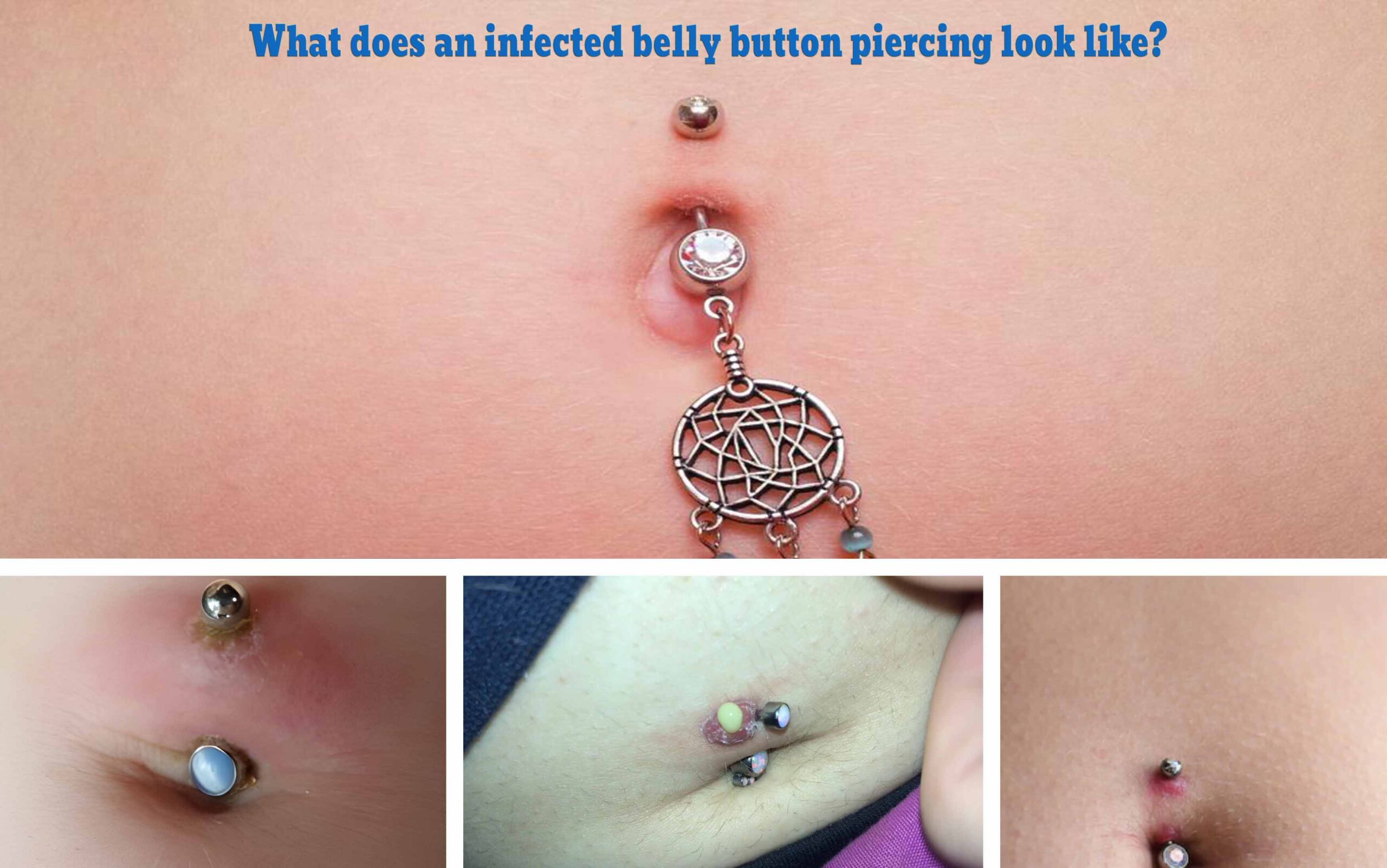 Belly Button Infections Pictures