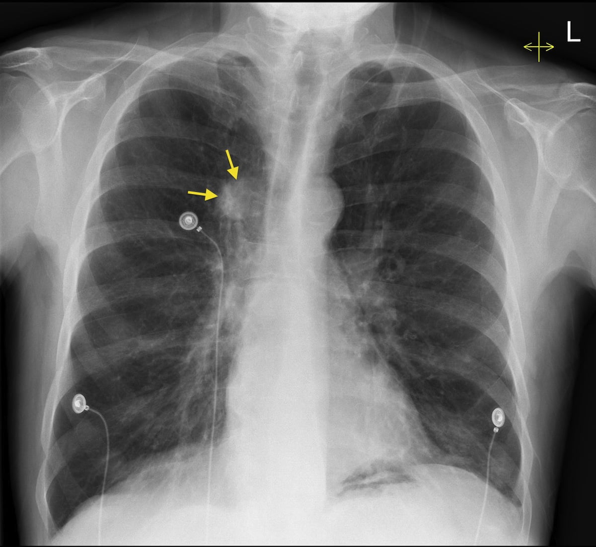 An x-ray image of a chest showing a tumor in the lung An x-ray image of a chest showing a tumor in the lung