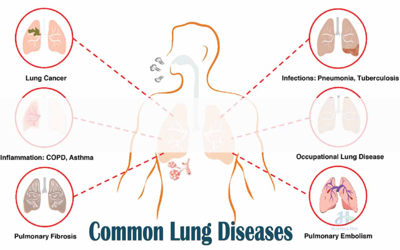 What Cause Lungs Disease at Conrad Wehr blog