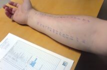 How do you read the results of an allergy skin test?