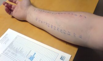 How do you read the results of an allergy skin test?