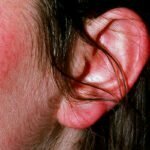 A lupus rash isn’t itchy and appears as red bumps on sun-exposed areas of skin.
