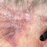 Lichen planus lesions are known to be purplish.