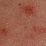red rash of measles