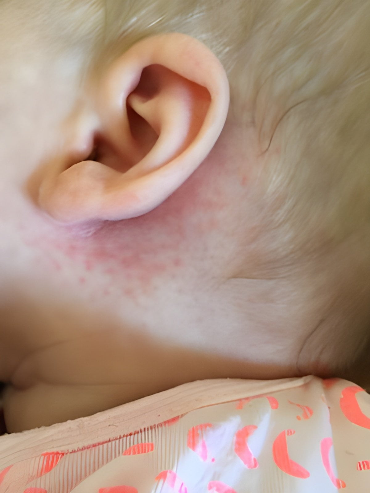 Rash behind the ear in a baby and toddler