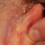 What can cause a rash behind the ear?