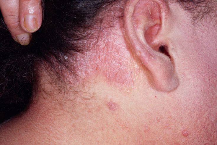 Rash Behind Ear: Causes, Symptoms & Treatments [With Photos]