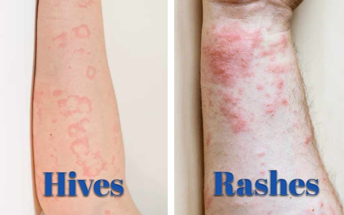 rash-vs-hives-how-to-identify-and-treat-them-naturally