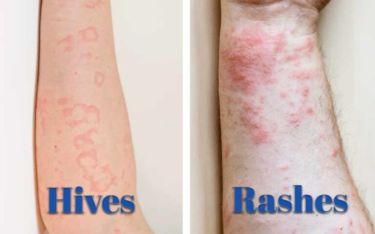 Rash Vs Hives How To Identify And Treat Them Naturally 6088