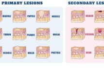 Types of Skin Lesions