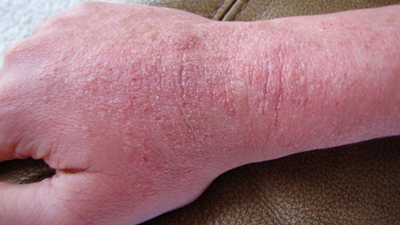 Chàm (eczema) là một bệnh ngoài da, chiếm 1/4 trên tổng số các bệnh ngoài da và có ảnh hưởng không nhỏ đến sức khoẻ và thẩm mỹ người mắc bệnh.
