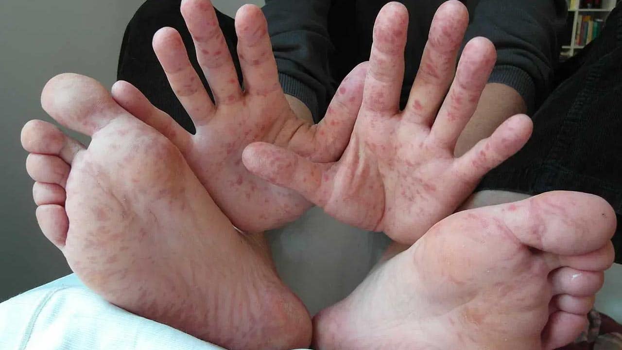 Bệnh tay, chân và miệng là một bệnh do virus phổ biến gây ra, thường ảnh hưởng đến trẻ sơ sinh và trẻ nhỏ dưới 5 tuổi.