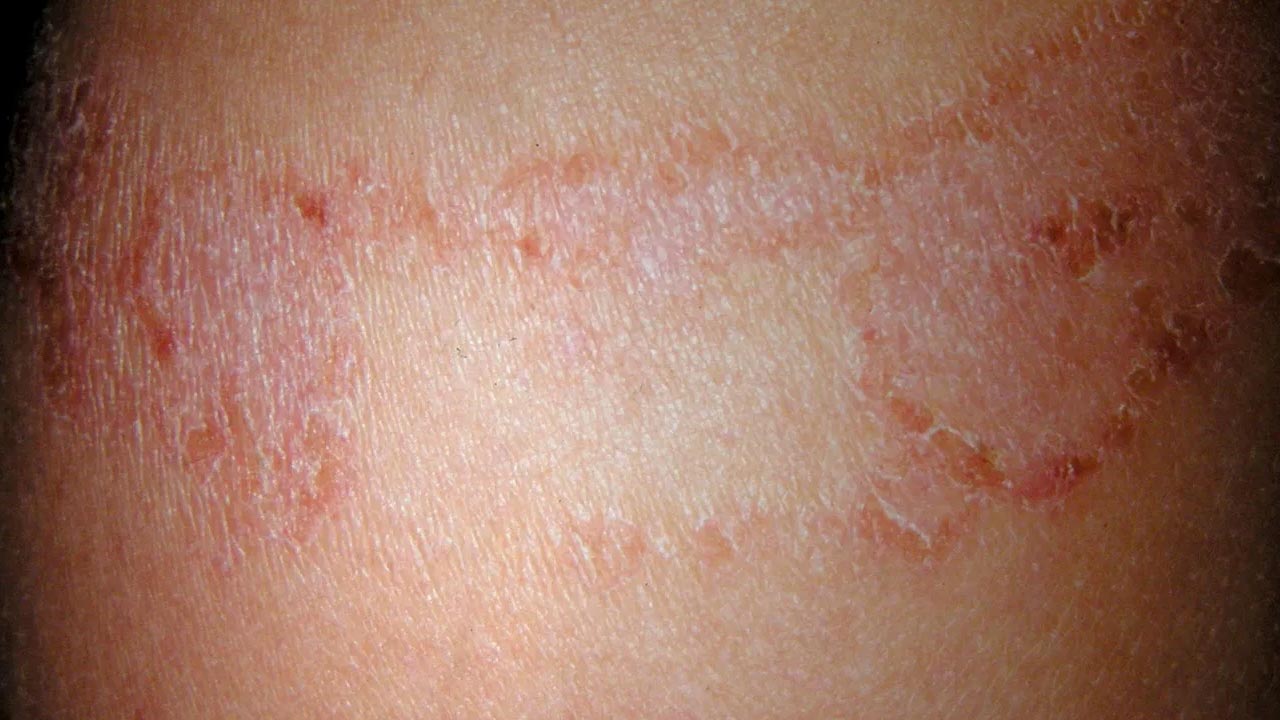 Chàm dị ứng hay còn gọi là viêm da dị ứng, là một tình trạng bệnh lý thường gặp ở da, đối tượng nào cũng có thể mắc phải.