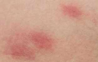 Phát Ban: 22 Loại Phát Ban Trên Da Thường Gặp, Nguyên Nhân và Cách Điều Trị Phát ban trên da
